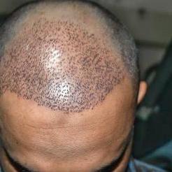 Hair Transplant In Riyadh