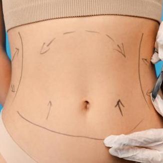 Liposuction Procedure In Riyadh